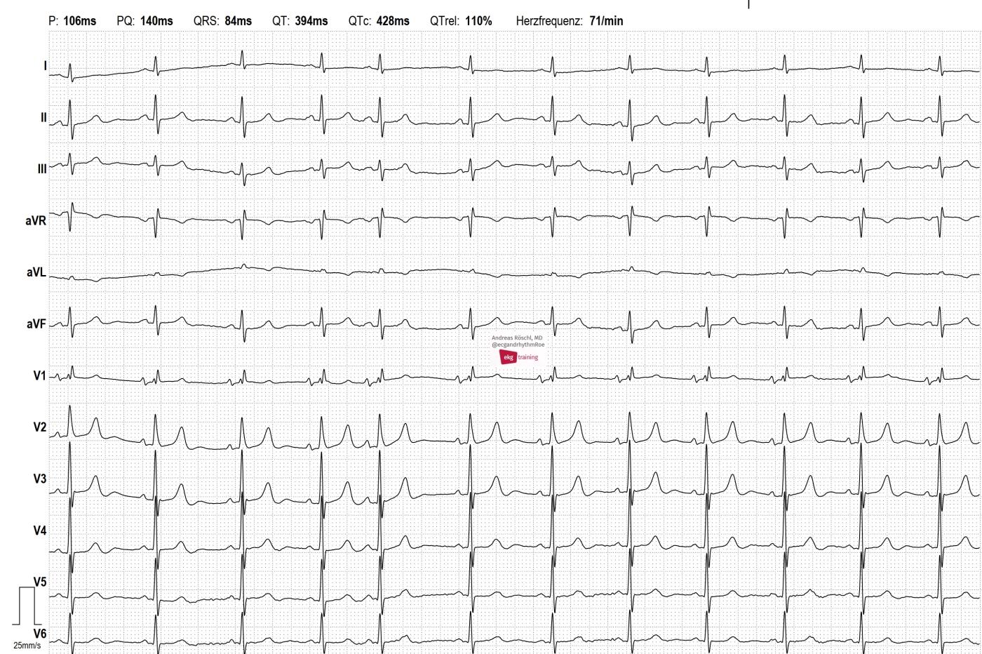 non-respiratory-sinus-arrhythmia-ecg-guru-instructor-resources